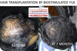 Biostimulation FUE Hair Transplant Delhi India- Bio FUE Hair Transplant