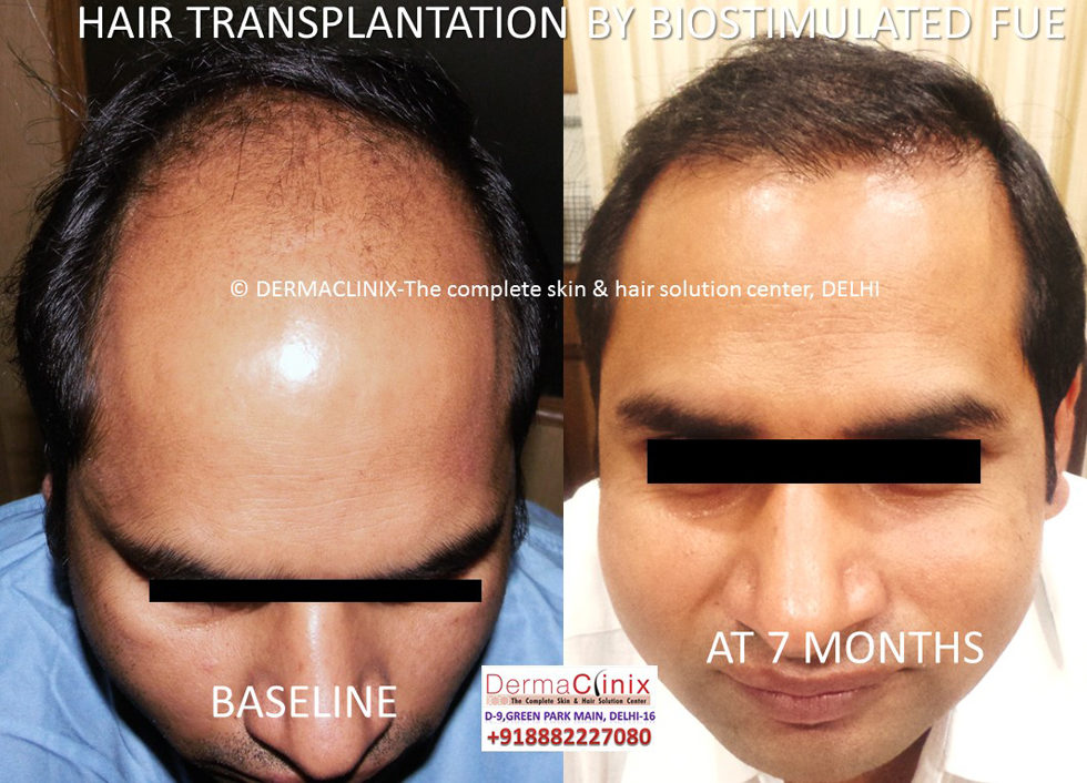 Biostimulation FUE Hair Transplant Delhi India- Bio FUE Hair Transplant